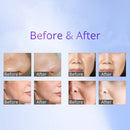 Shape Tactics 8-in-1 RF Skin Tightening with Hot & Cold Hammer BIO Anti-Aging