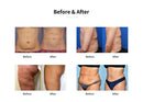Shape Tactics - Dual Handle Fat Freezing Ultrasound Cavitation RF Machine