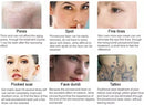 Shape Tactics - Precision Picosecond Laser for Freckles and Tattoo Removal