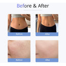 Shape Tactics - Cavitación ultrasónica EMS de vacío de 30 K con forma de S