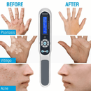Shape Tactics UVB 311nm Phototherapy Device